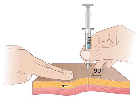 Cannula versus Needle Manila: Aesthetic Treatments