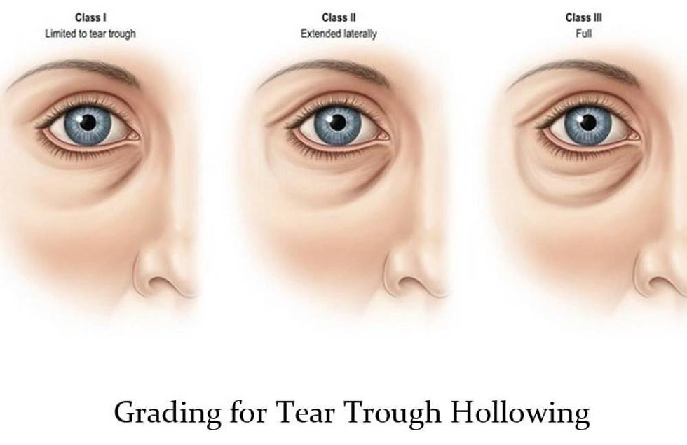 causes-of-tear-troughs