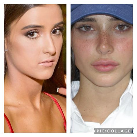 celebrities with filler