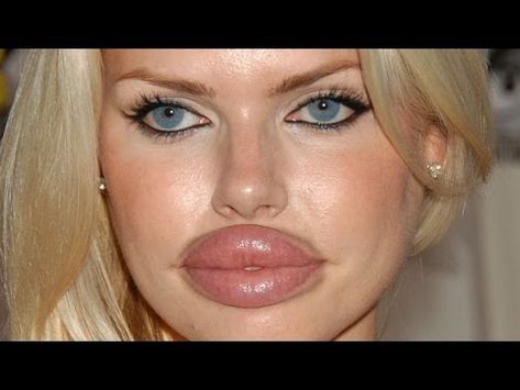 Celebs with Bad Botox