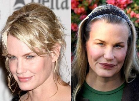 Celebs with Bad Botox