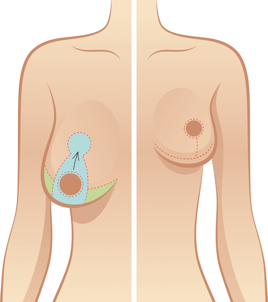 comparison-non-surgical-vs-surgical-breast-augmentation