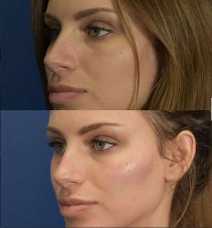 dermal filler injection techniques for cheeks