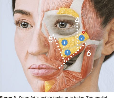 dermal filler injection techniques for cheeks