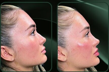 dermal filler injection techniques for cheeks