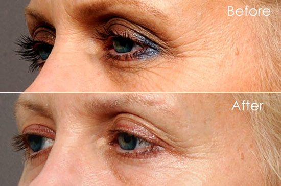 Discovering the Wonders of Crows Feet Botox