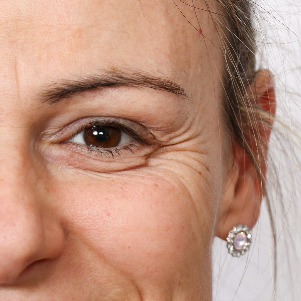 Discovering the Wonders of Crows Feet Botox