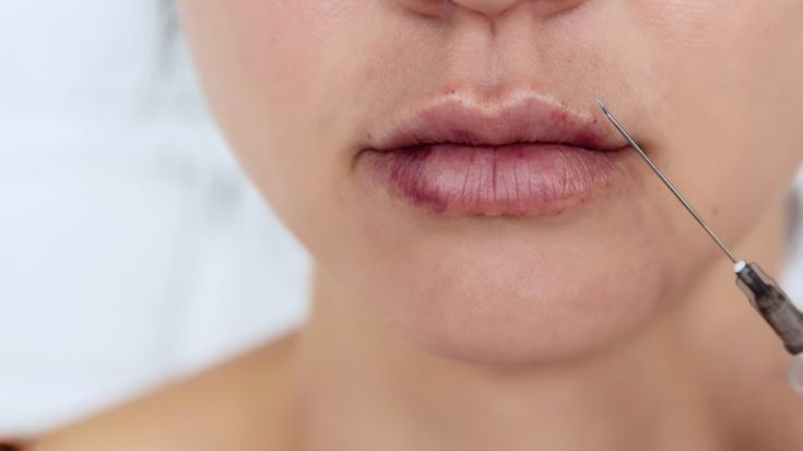 dos and don'ts after lip filler philippines