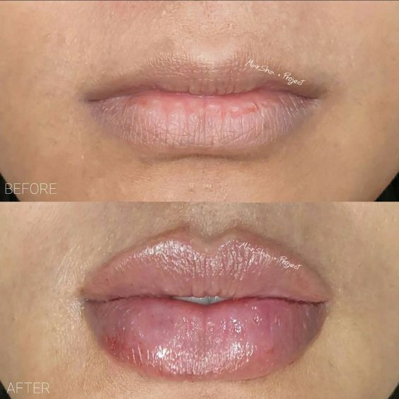 Dos and Don’ts After Lip Filler Treatment