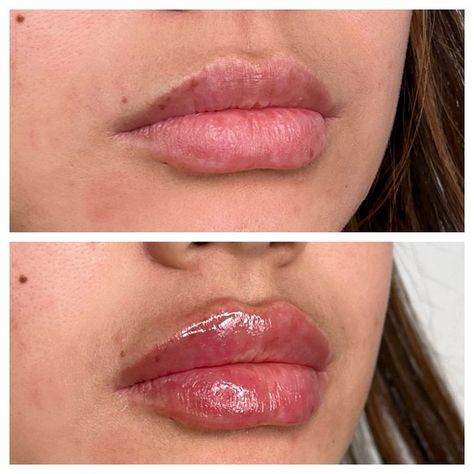 Dos and Don’ts After Lip Filler Treatment