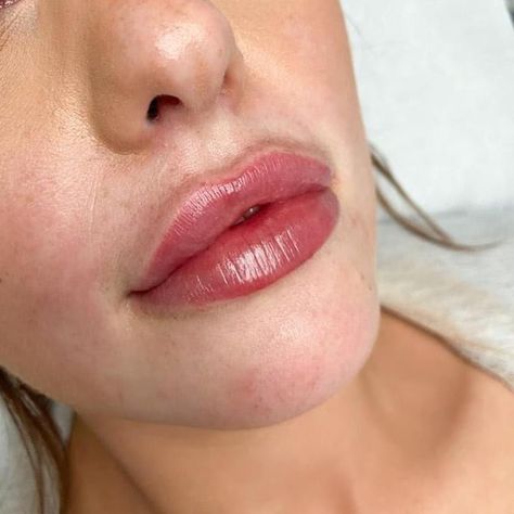 Dos and Don’ts After Lip Filler Treatment