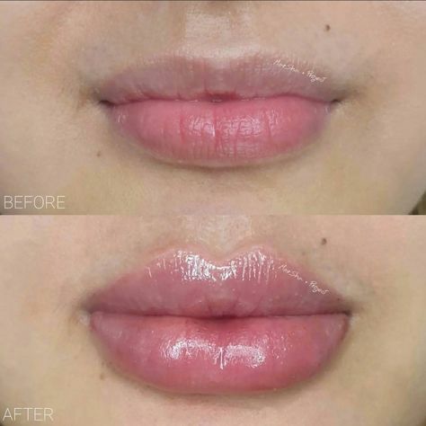 Dos and Don’ts After Lip Filler Treatment