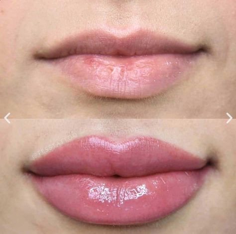 Dos and Don’ts After Lip Fillers Before and After