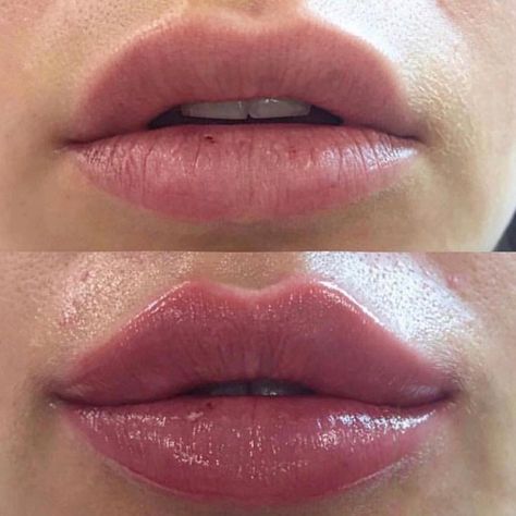 Dos and Don’ts After Lip Fillers Before and After