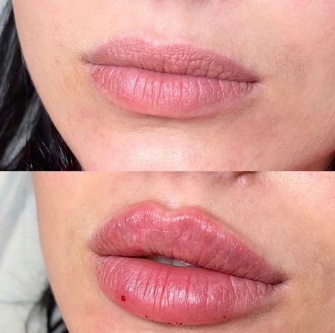 Dos and Don’ts After Lip Fillers Before and After