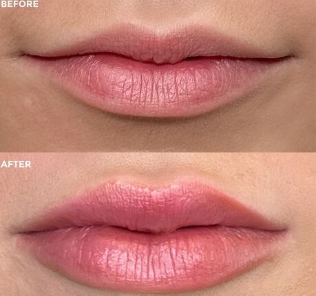 Dos and Don’ts After Lip Fillers Before and After