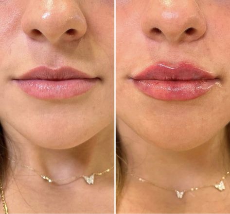 Dos and Don’ts After Lip Fillers Before and After