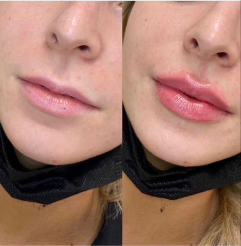 Dos and Don’ts After Lip Fillers Before and After