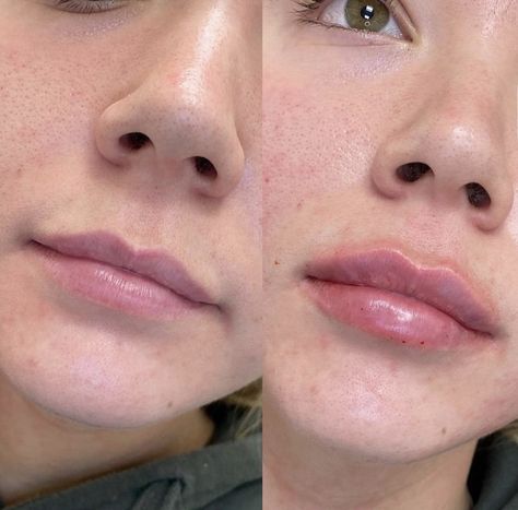 Dos and Don’ts After Lip Fillers Before and After