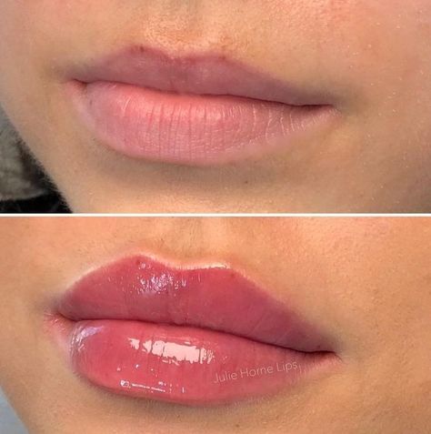 Dos and Don’ts After Lip Fillers Before and After