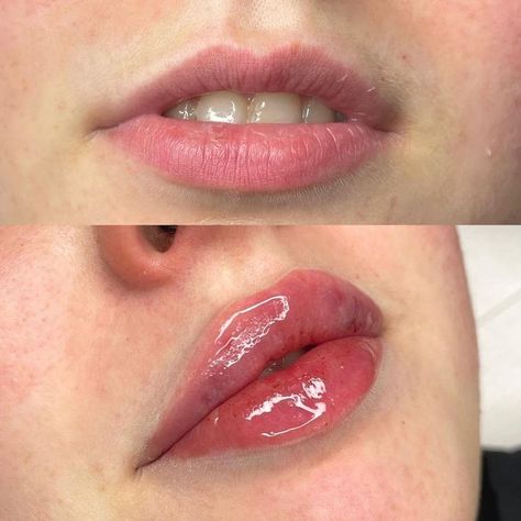 Dos and Don’ts After Lip Fillers Before and After