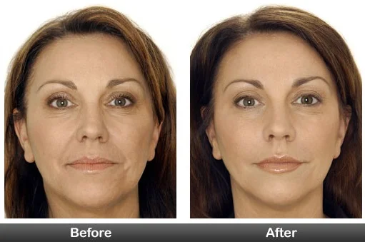 expected-results-before-and-after-botox-treatment