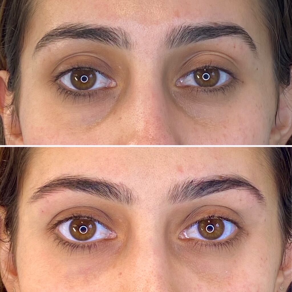 eye-lift-fillers