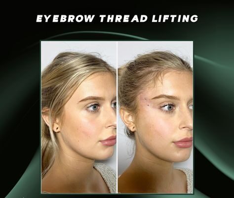 Eyebrow Before and After Threading Quezon