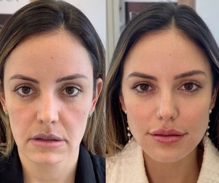 eyebrow lift filler before and after