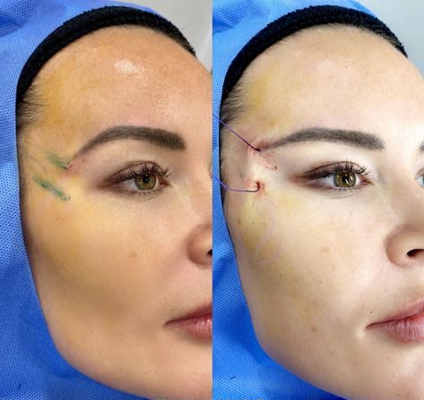 eyebrow lift filler before and after