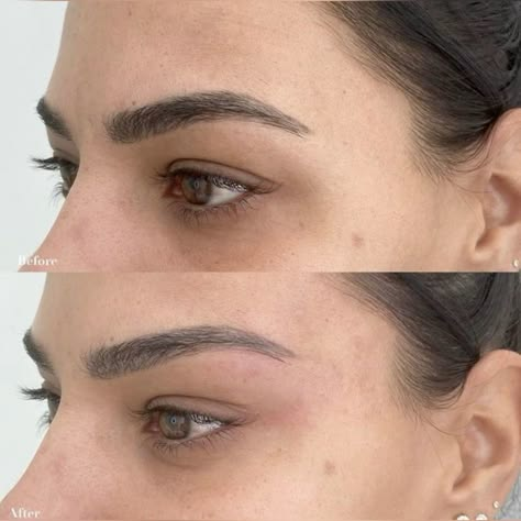 eyebrow lift filler before and after