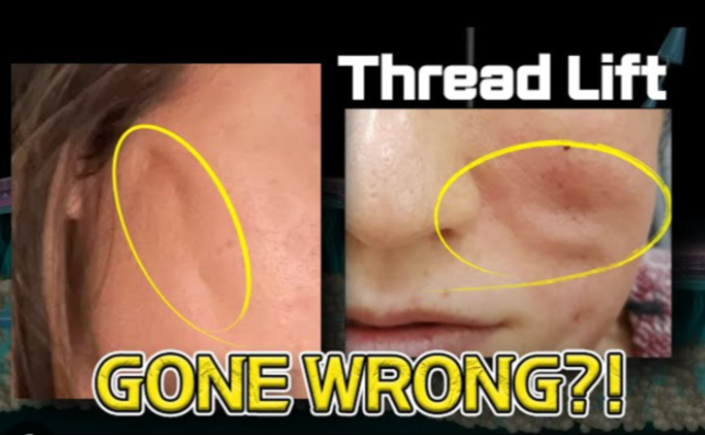 Face Threads Gone Wrong: How to Avoid Complications