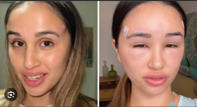 Face Threads Gone Wrong: How to Avoid Complications