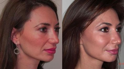 Facial Fillers Gone Wrong Manila: How to Avoid Them