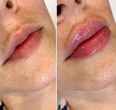 Healed Results of 1ml Lip Fillers Quezon