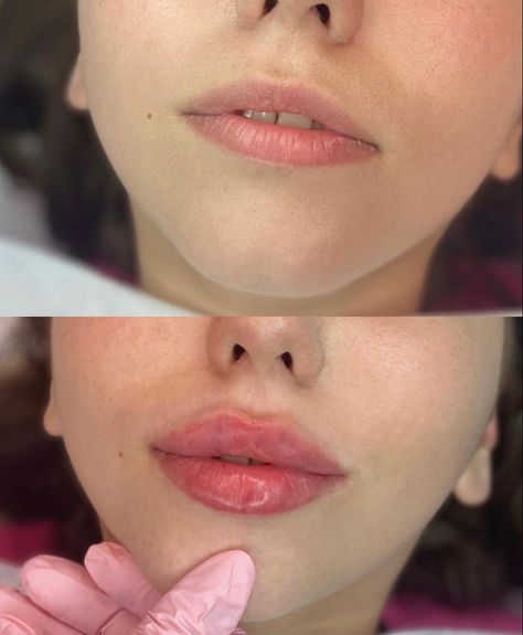 Healed Results of 1ml Lip Fillers Quezon