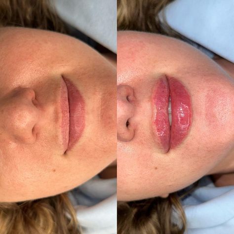 Healed Results of 1ml Lip Fillers Quezon