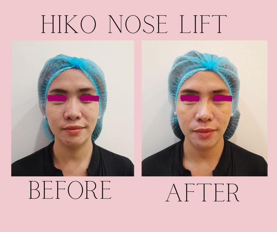 Hiko Nose Lift Before and After