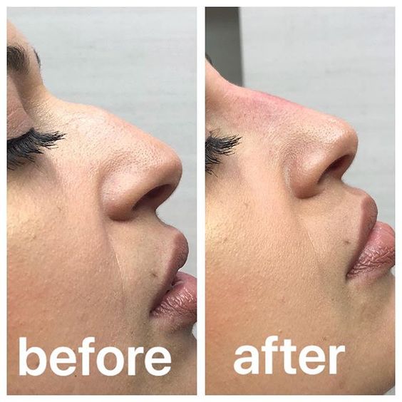 Hiko Nose Lift result