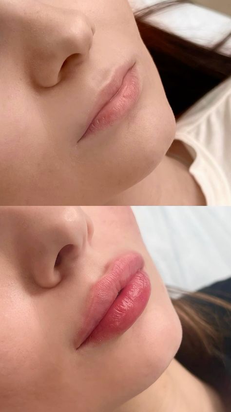 how much does 1/2 ml of lip filler cost philippines