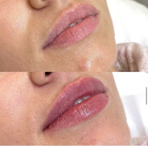 how much does 1/2 ml of lip filler cost philippines