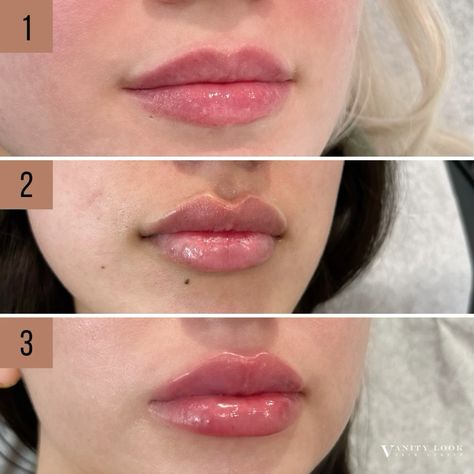 how much does 1/2 ml of lip filler cost philippines