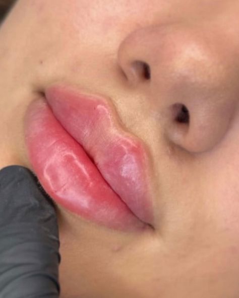 how much does 1/2 ml of lip filler cost philippines