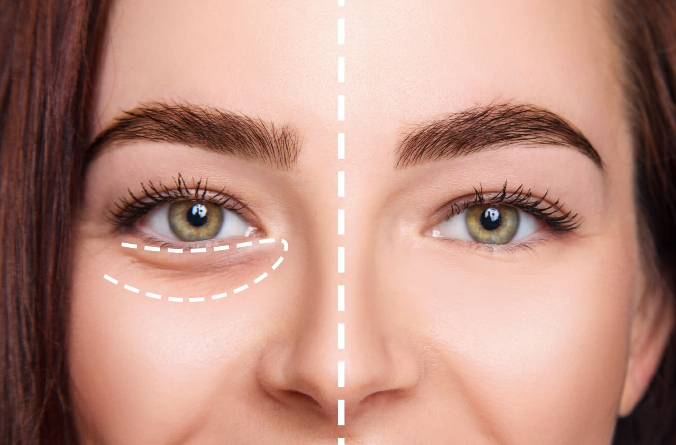 how-to-budget-for-under-eye-fillers