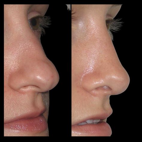 how to fix a bulbous nose tip without surgery