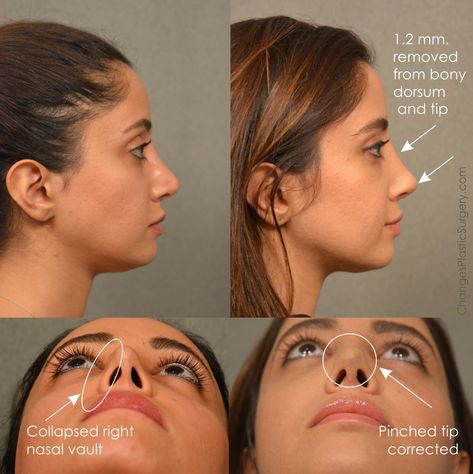 how to fix a bulbous nose tip without surgery