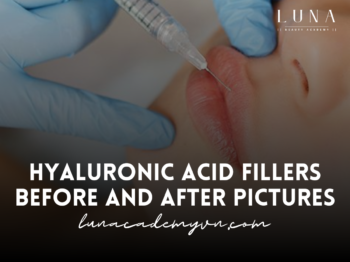 Hyaluronic Acid Fillers Before and After Pictures