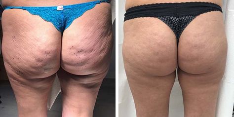 hyaluronic acid fillers for buttocks before and after