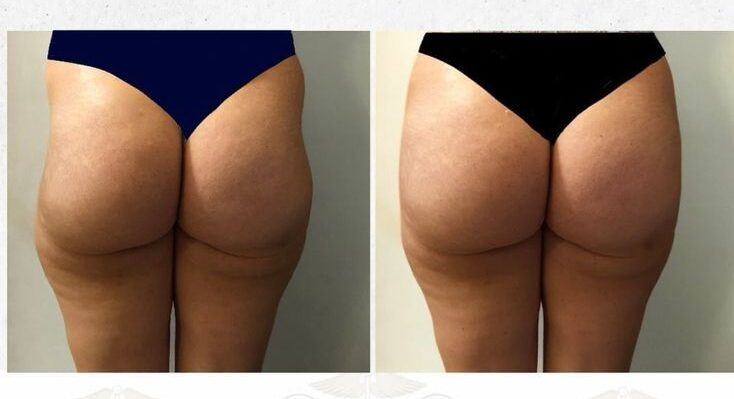 hyaluronic acid fillers for buttocks before and after