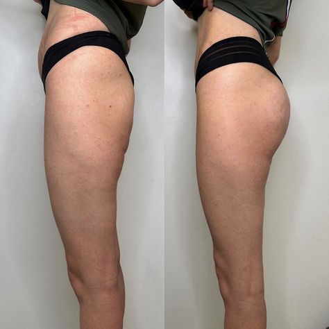 hyaluronic acid fillers for buttocks before and after